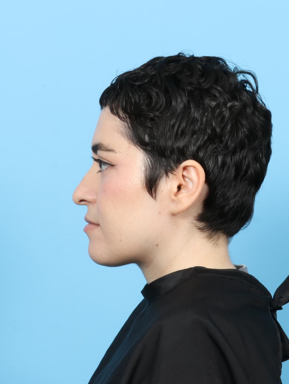 Rhinoplasty case #7668 before, image 1