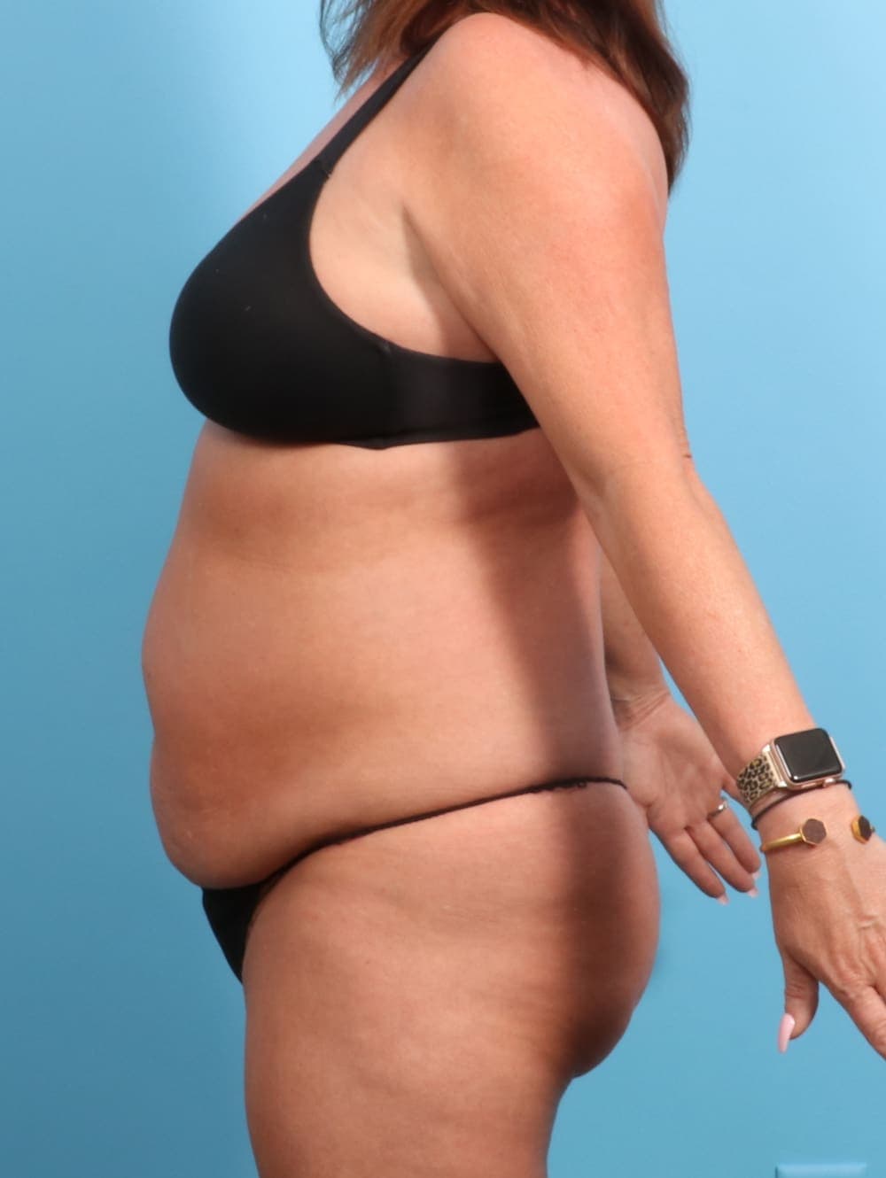 Tummy Tuck case #2330 before, image 3