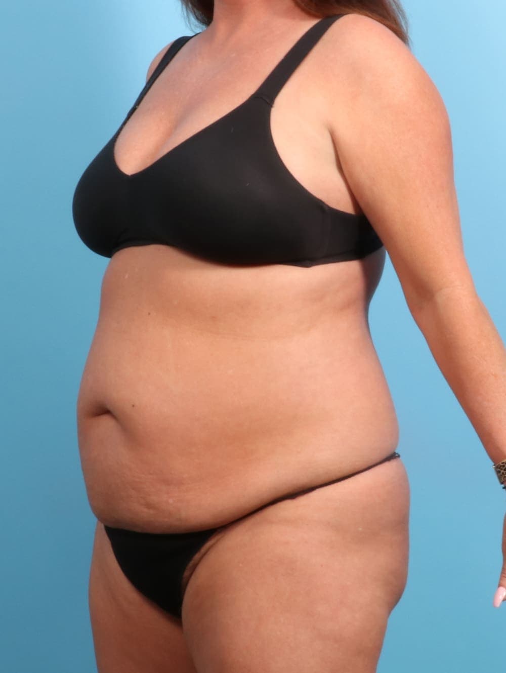 Tummy Tuck case #2330 before, image 2