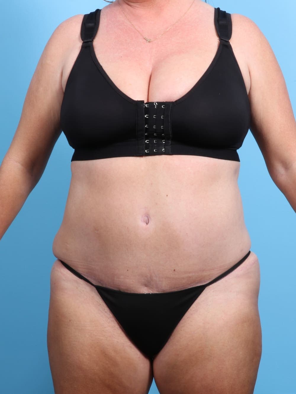 Tummy Tuck case #2330 after, image 1
