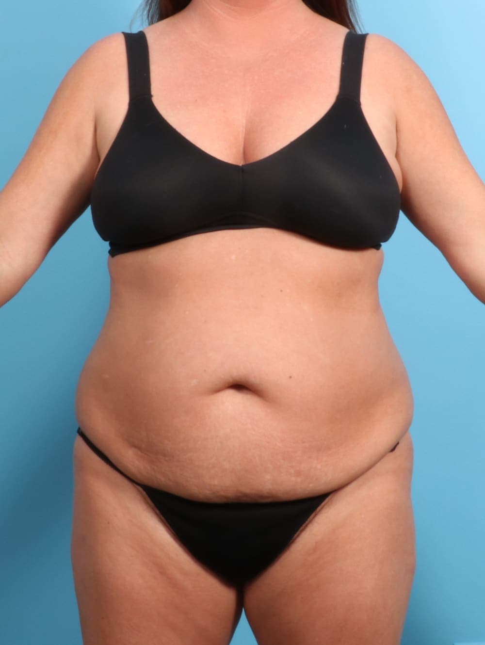 Tummy Tuck case #2330 before, image 1