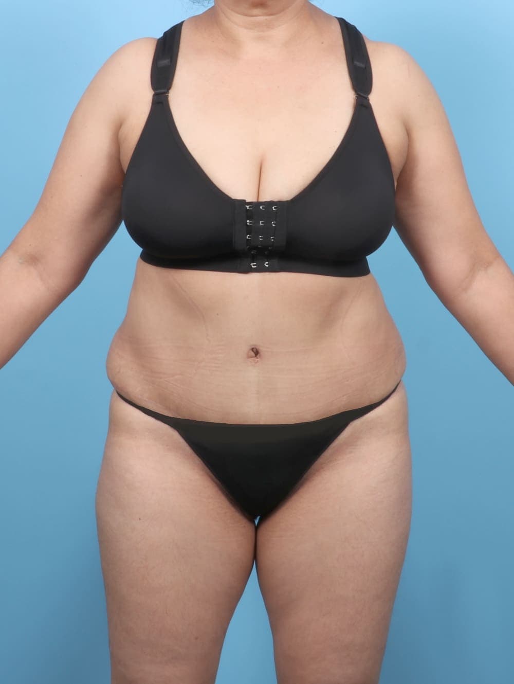Tummy Tuck case #6351 after, image 1
