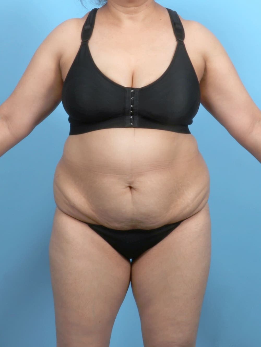 Tummy Tuck case #6351 before, image 1