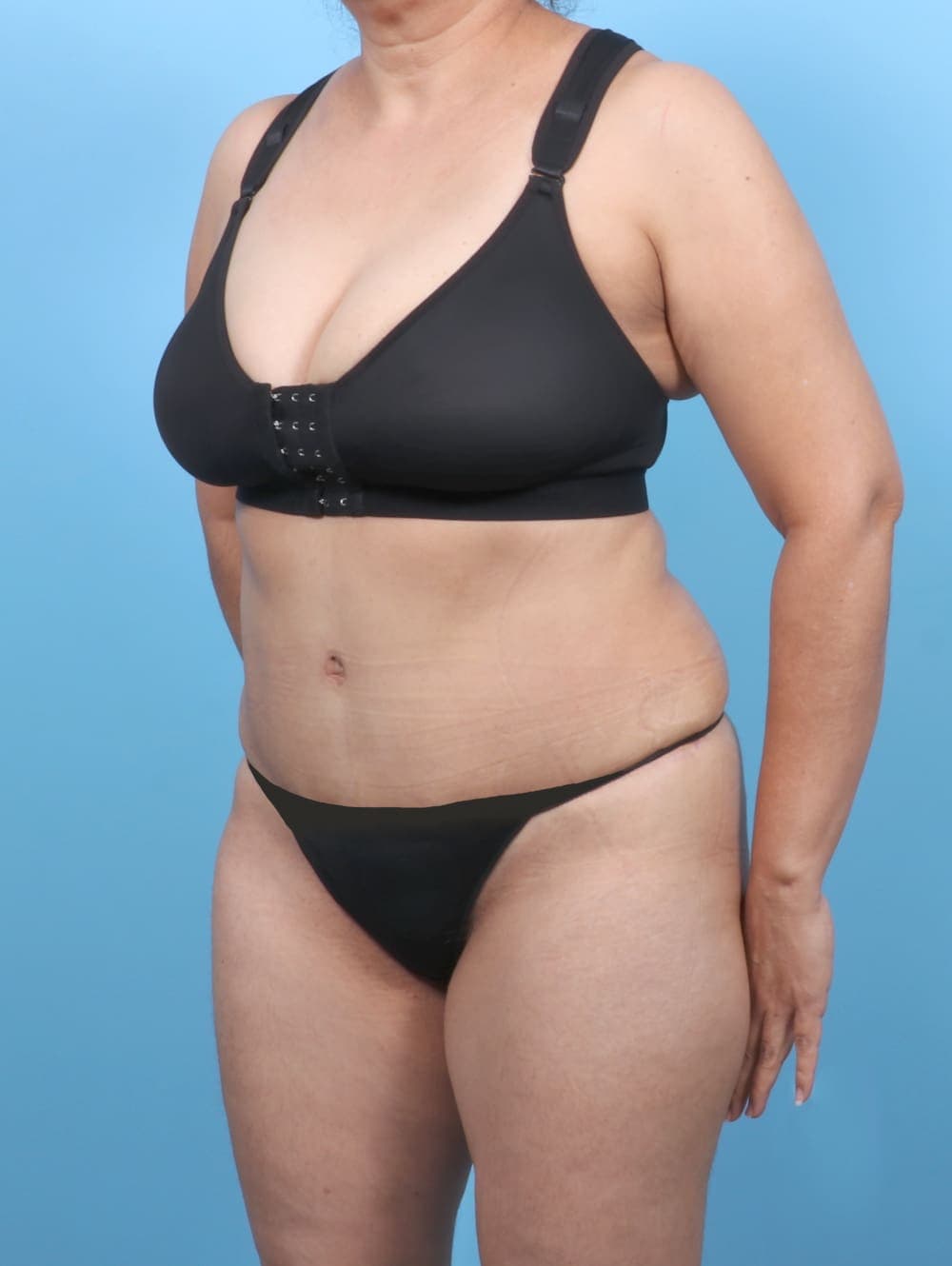 Tummy Tuck case #6351 after, image 2