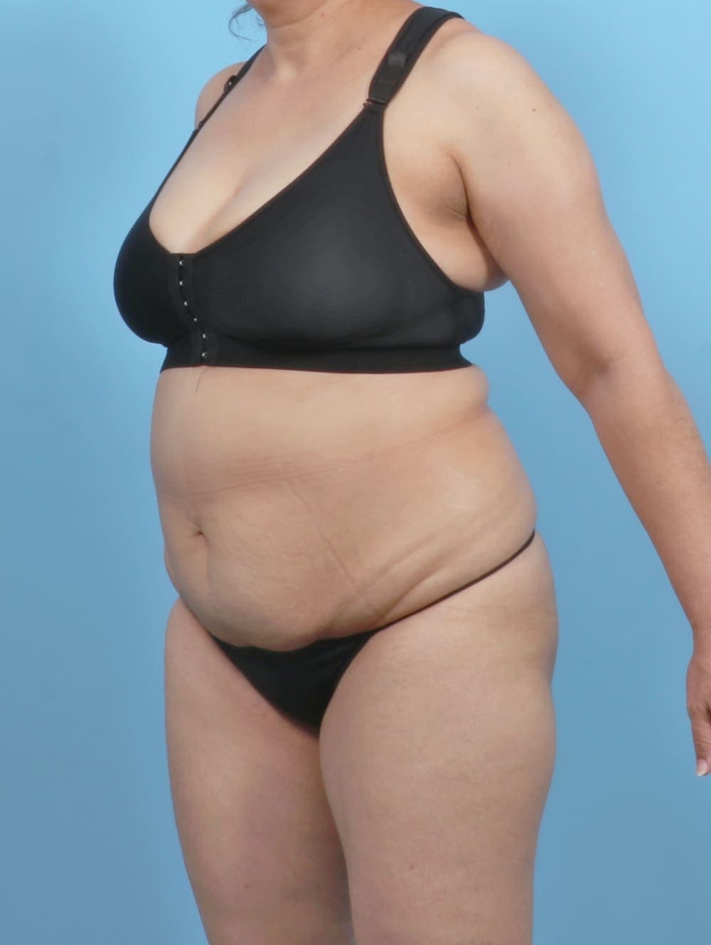 Tummy Tuck case #6351 before, image 2
