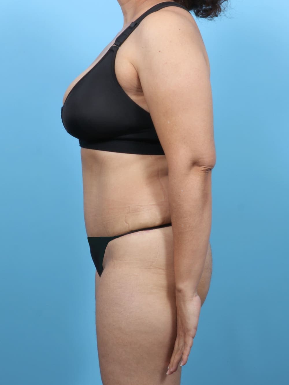 Tummy Tuck case #6351 after, image 3