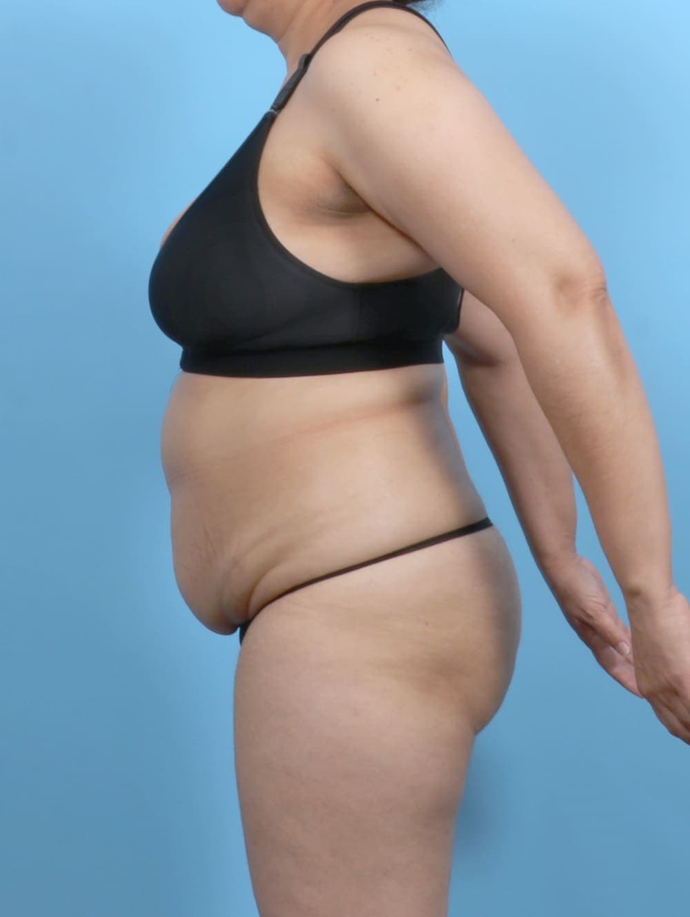 Tummy Tuck case #6351 before, image 3