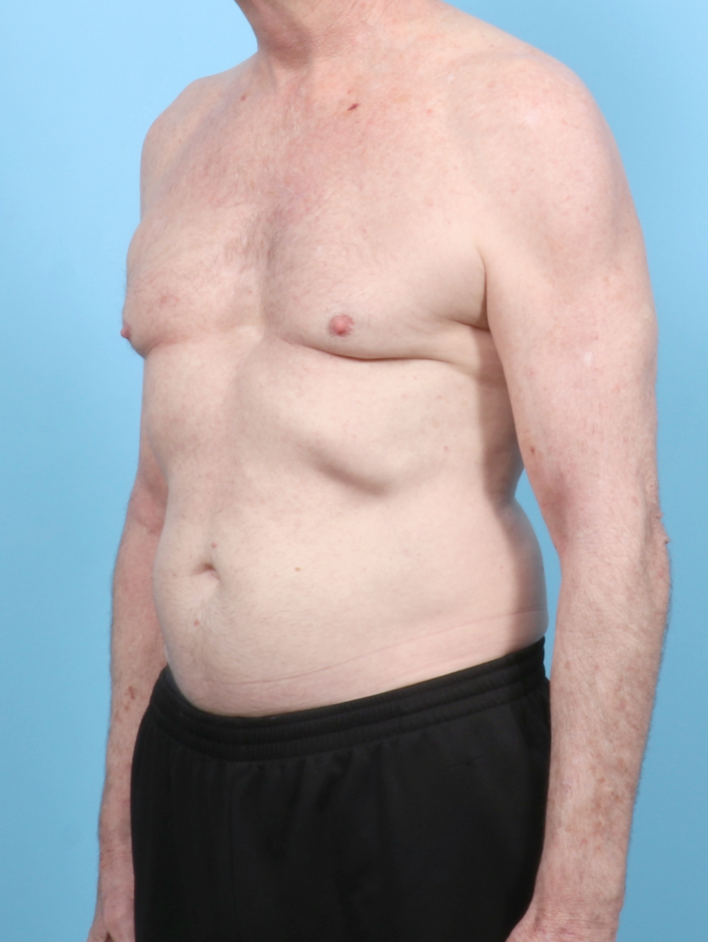 Male Breast Reduction Patient Photo - Case 6443 - before view-1