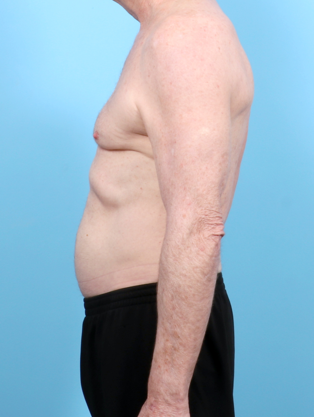 Male Breast Reduction Patient Photo - Case 6443 - before view-2