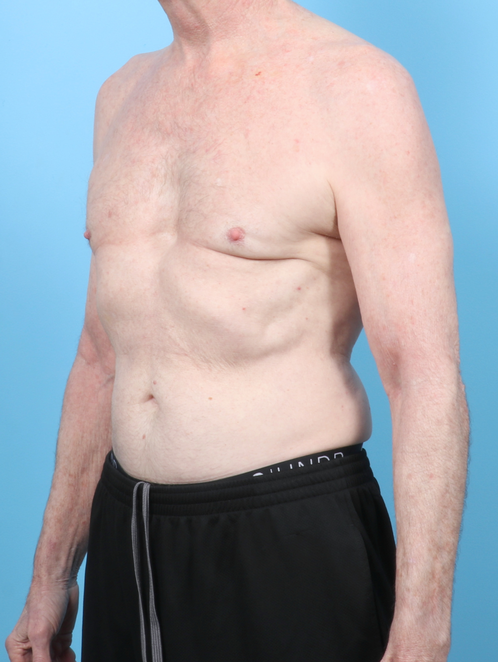 Male Breast Reduction Patient Photo - Case 6443 - after view-1