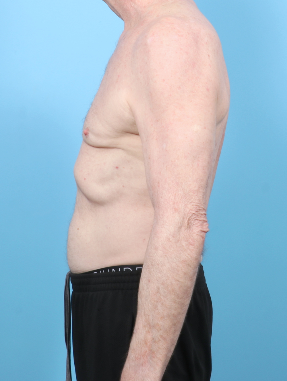 Male Breast Reduction Patient Photo - Case 6443 - after view-2