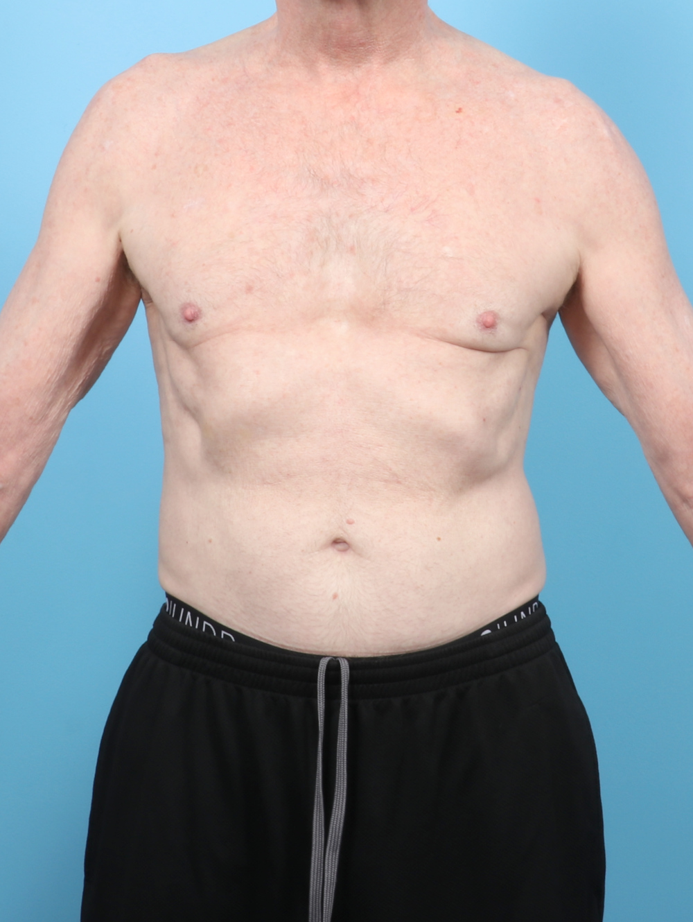 Male Breast Reduction Patient Photo - Case 6443 - after view
