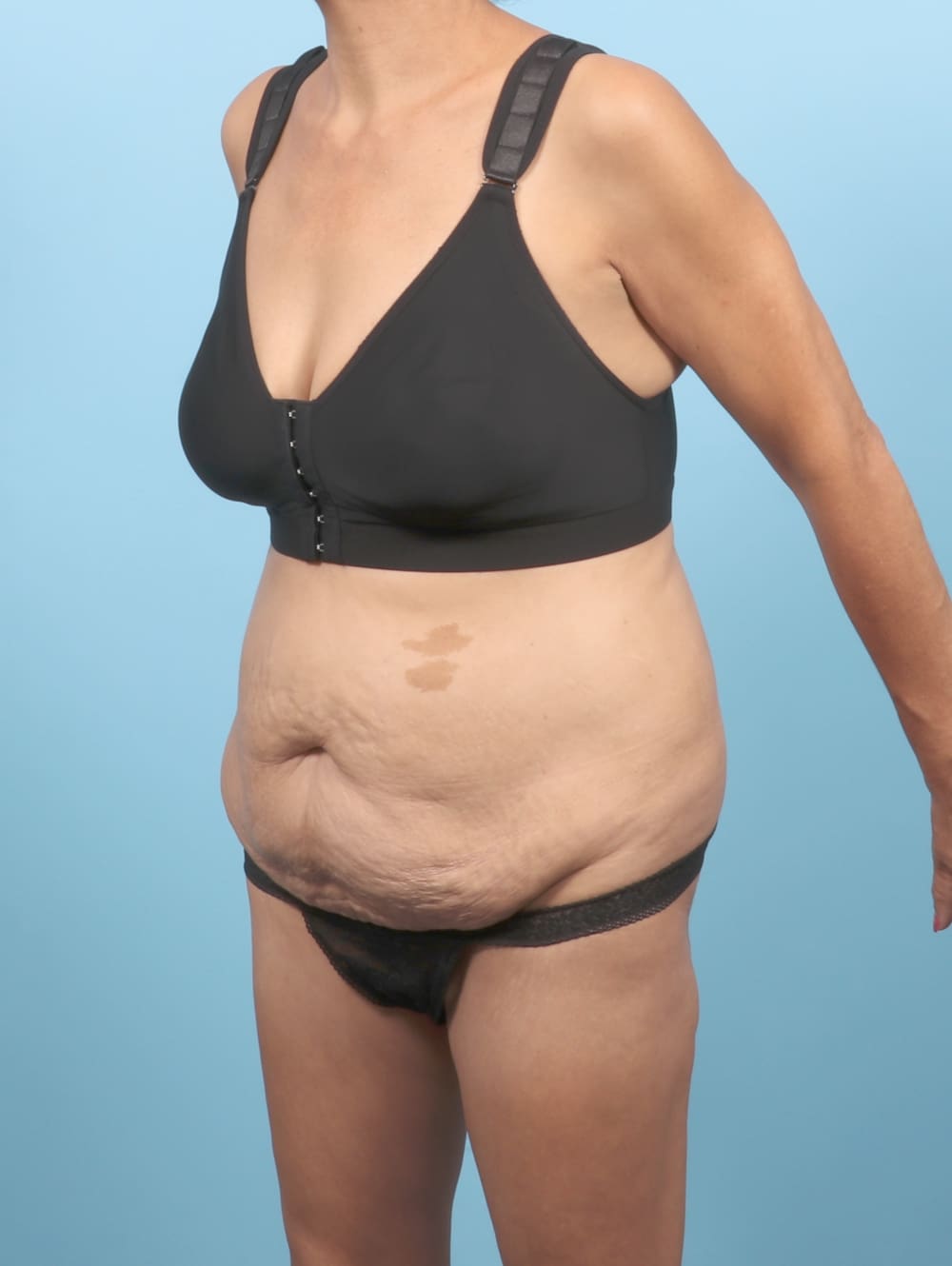 Liposuction Patient Photo - Case 6651 - before view-1