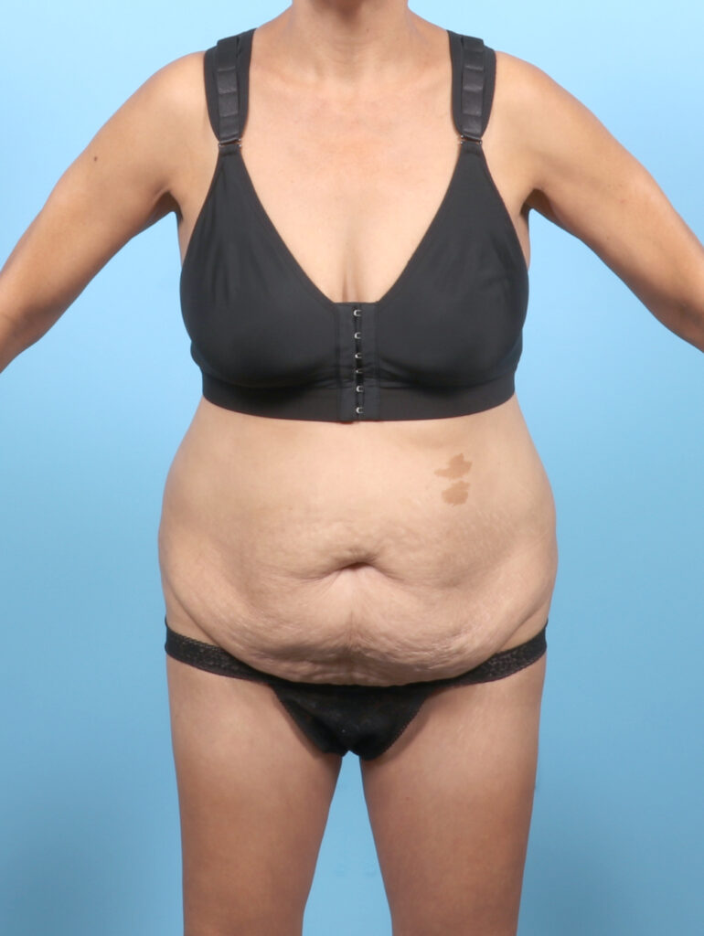 Liposuction - Case 6651 - Before