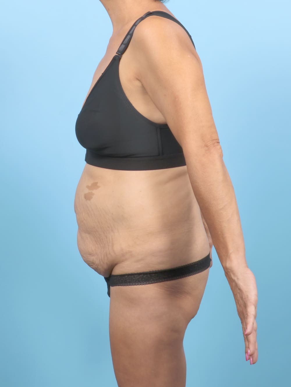 Liposuction Patient Photo - Case 6651 - before view-2