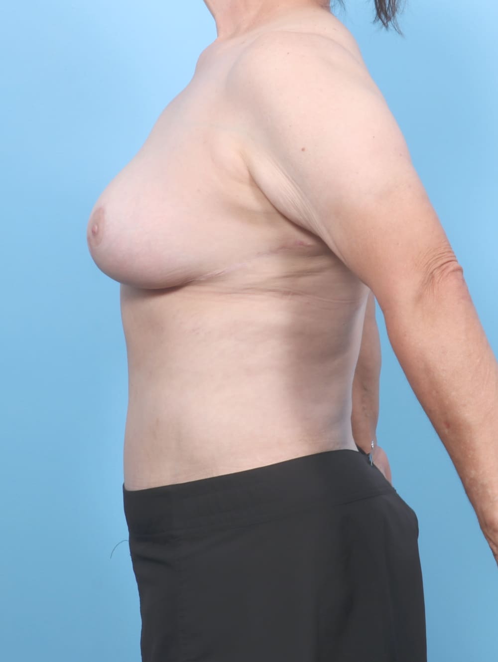 Breast Lift/Reduction Patient Photo - Case 6677 - after view-2