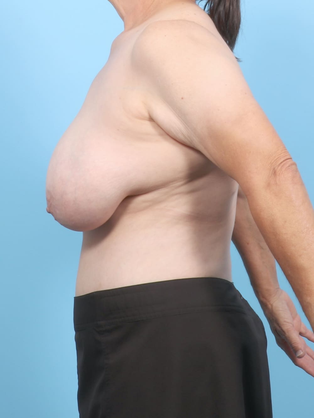 Breast Lift/Reduction Patient Photo - Case 6677 - before view-2