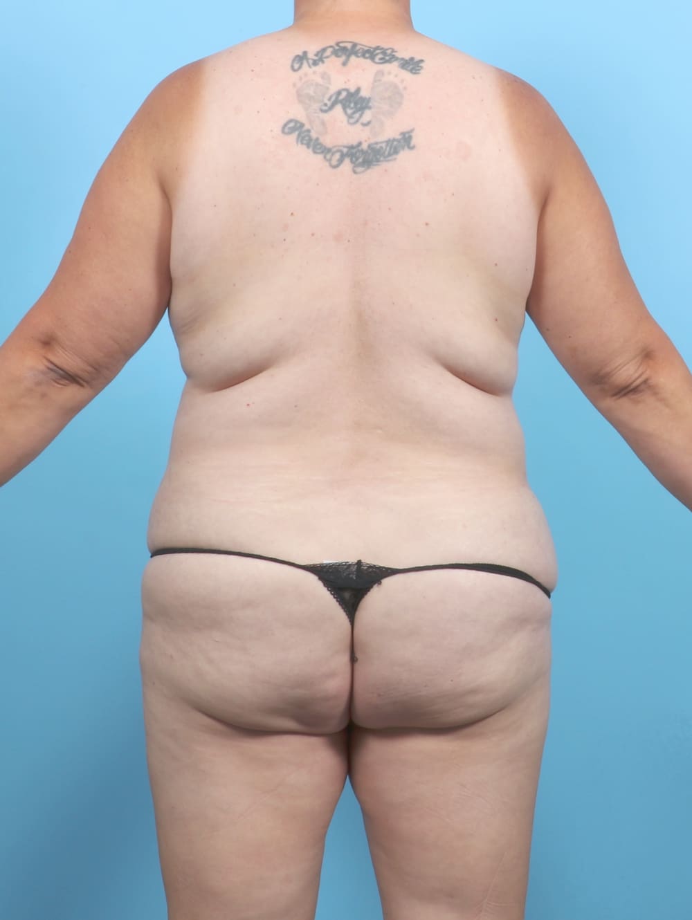 Tummy Tuck Patient Photo - Case 6707 - before view-3