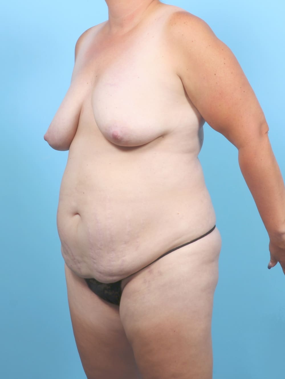 Tummy Tuck Patient Photo - Case 6707 - before view-1