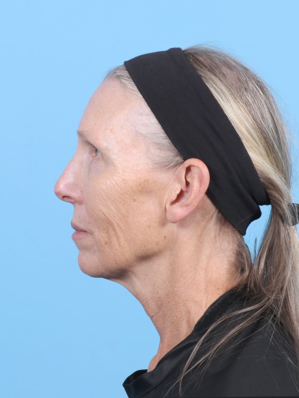 Facelift Patient Photo - Case 6725 - before view-2