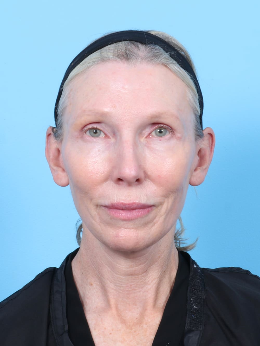 Facelift Patient Photo - Case 6725 - after view