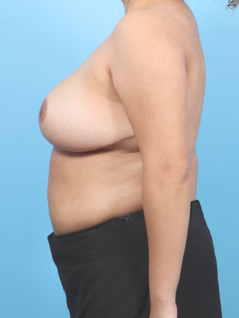 Breast Lift/Reduction Patient Photo - Case 6735 - after view-2