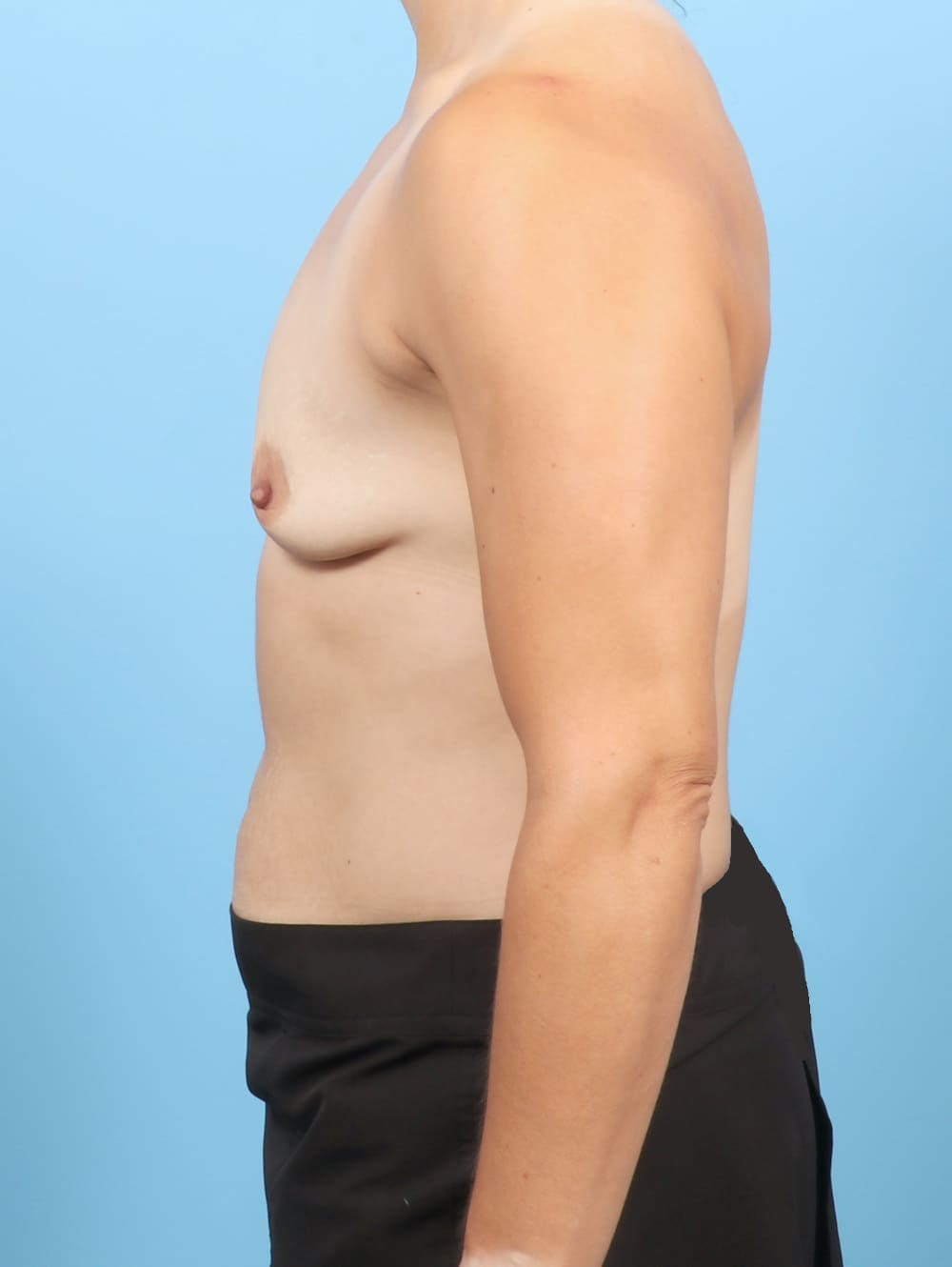 Breast Augmentation Patient Photo - Case 6743 - before view-2