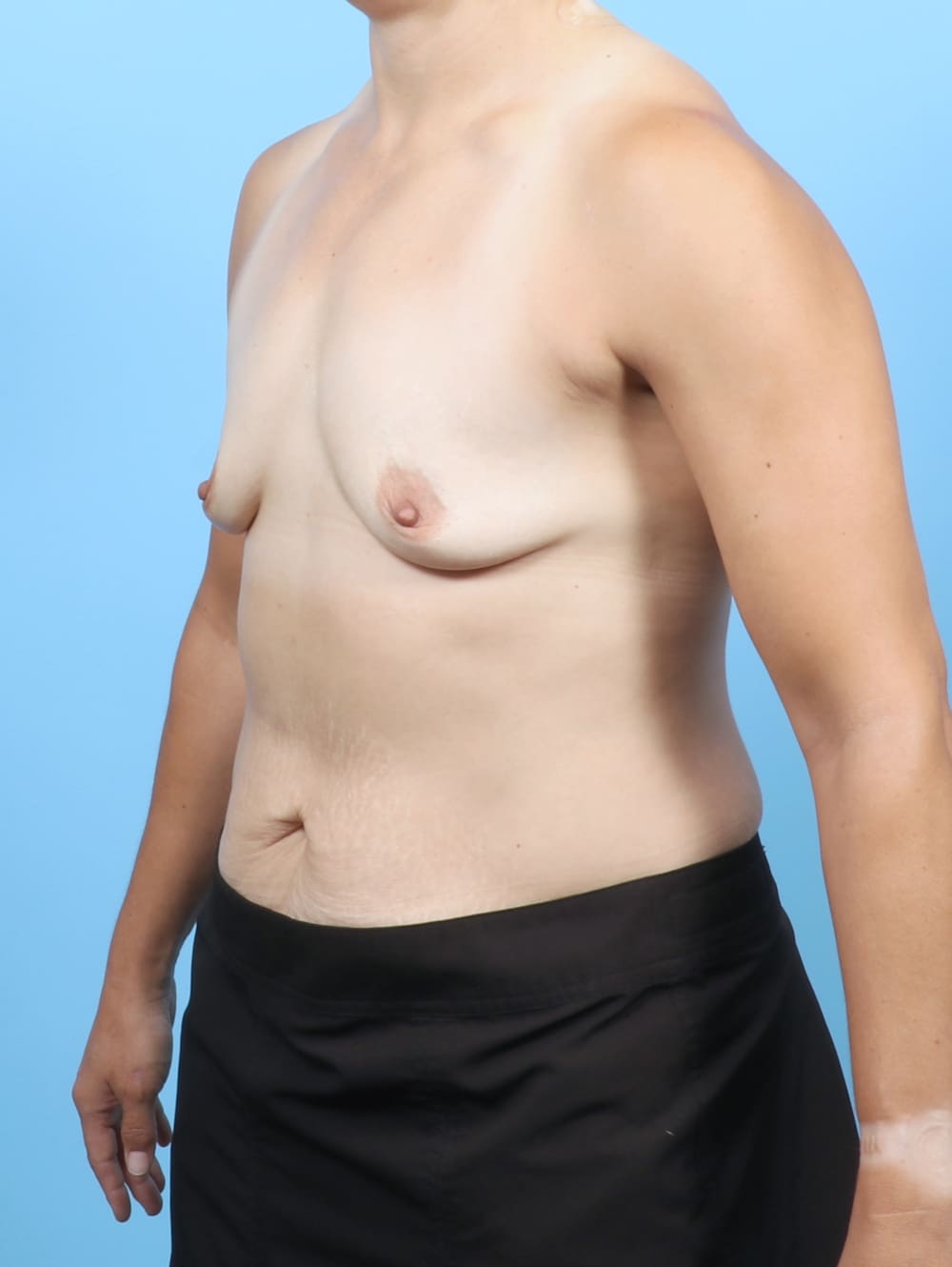 Breast Augmentation Patient Photo - Case 6743 - before view-1