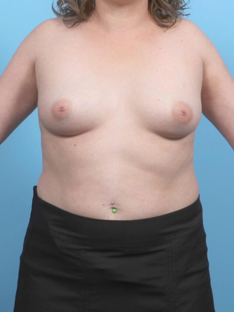 Breast Augmentation - Case 6759 - Before