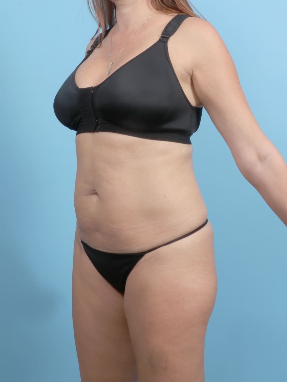 Tummy Tuck Patient Photo - Case 6767 - before view-1