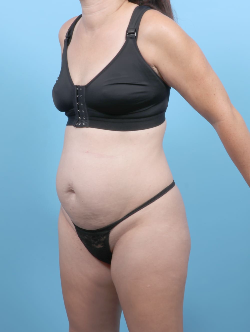 Tummy Tuck Patient Photo - Case 6777 - before view-1