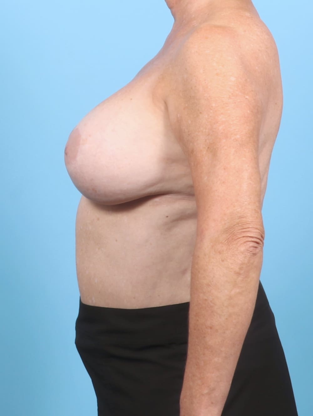 Breast Implant Removal with Lift Patient Photo - Case 6785 - before view-2