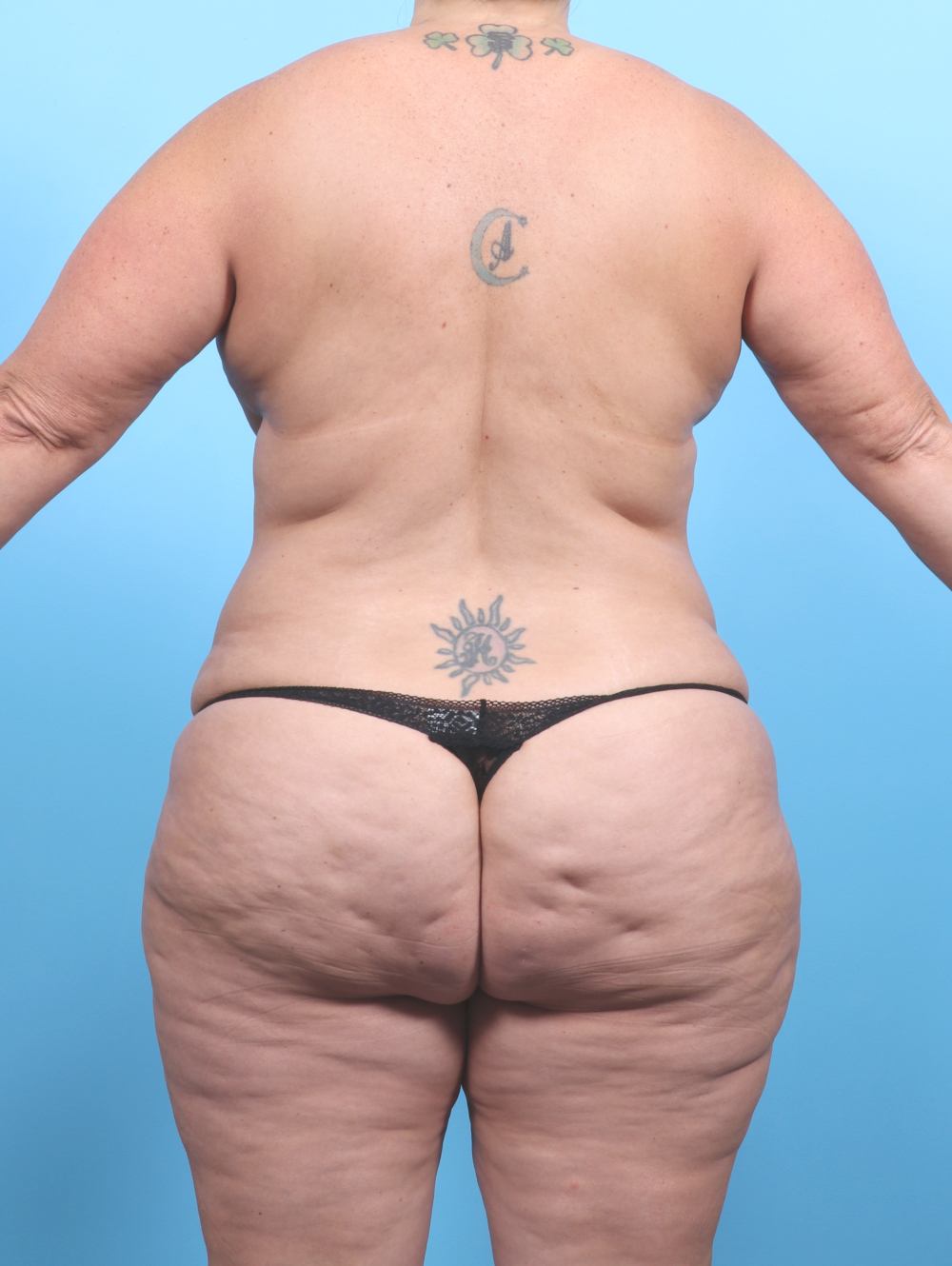 Liposuction Patient Photo - Case 6793 - before view-3