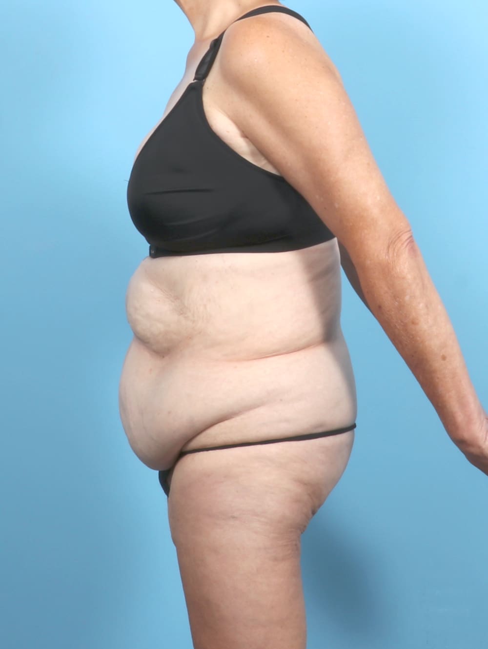 Tummy Tuck Patient Photo - Case 6885 - before view-2